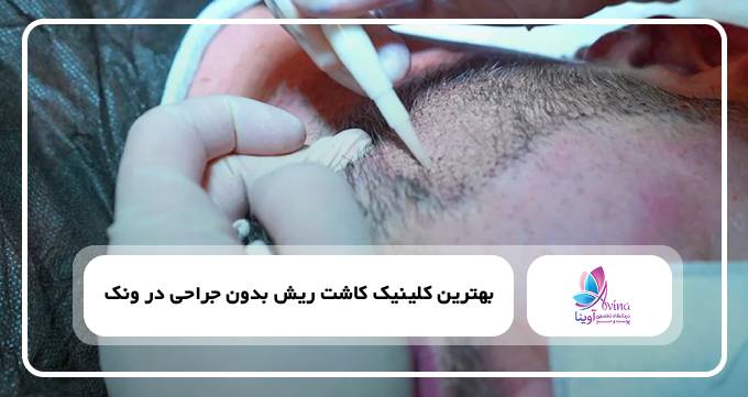 بهترین کلینیک کاشت ریش بدون جراحی در ونک✅【سال۱۴۰۴】⚡