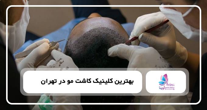 بهترین کلینیک کاشت مو در تهران