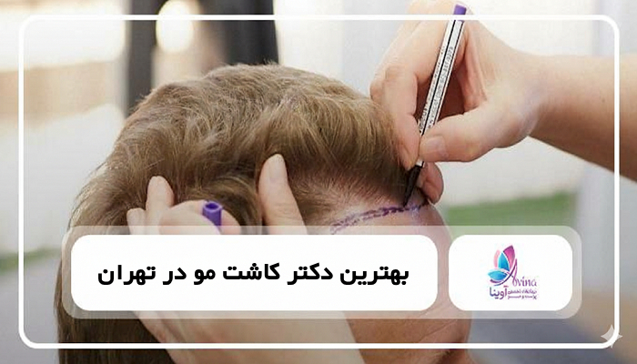 بهترین دکتر کاشت مو در تهران