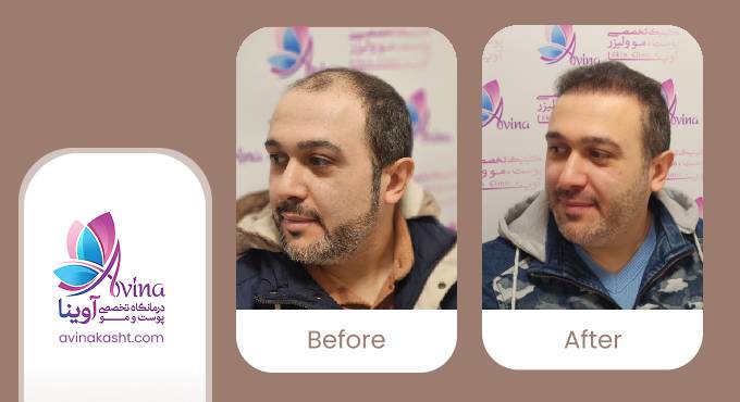 چگونه می‌توان بهترین نتیجه را از کاشت مو گرفت؟