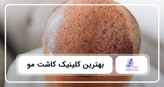 بهترین کلینیک کاشت مو