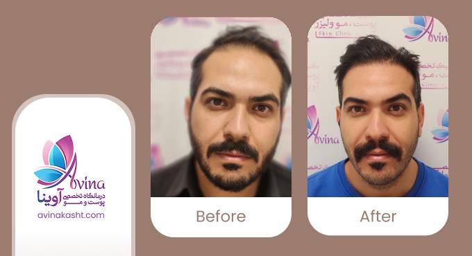 روشهای نوین کاشت مو در کلینیک آوینا