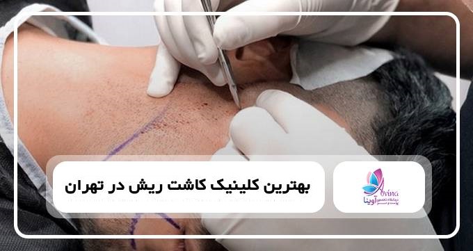 بهترین کلینیک کاشت ریش در تهران