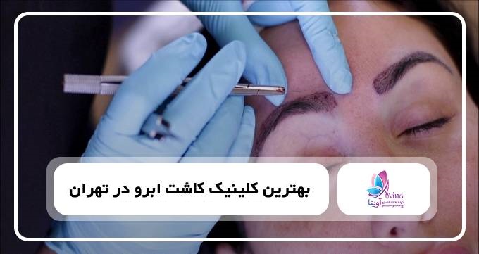 بهترین کلینیک کاشت ابرو در تهران