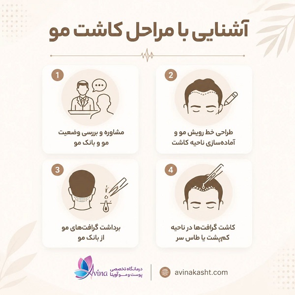 آشنایی با مراحل کاشت مو