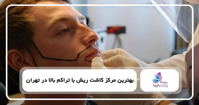 بهترین مرکز کاشت ریش با تراکم بالا در تهران