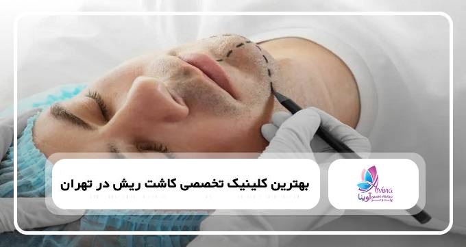 بهترین کلینیک تخصصی کاشت ریش در تهران