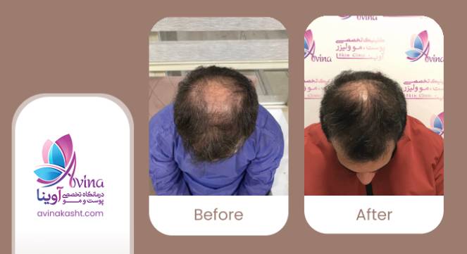 نمونه کار کاشت مو در کلینیک آوینا