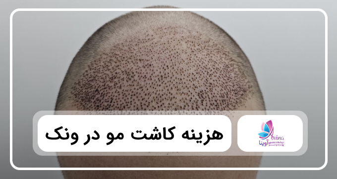 هزینه کاشت مو در ونک ✅【سال۱۴۰۵】❤️