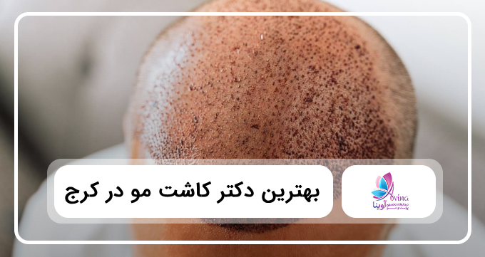 بهترین دکتر کاشت مو در کرج 💗【سال1405】