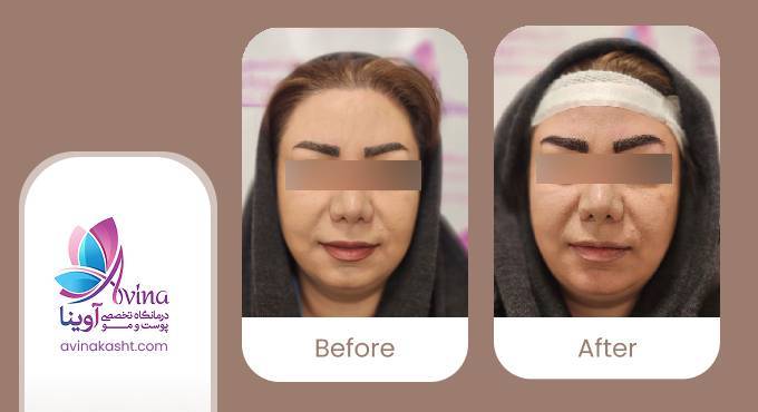 نمونه کار کاشت ابرو در کلینیک آوینا