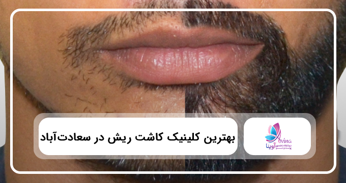 بهترین کلینیک کاشت ریش در سعادت آباد