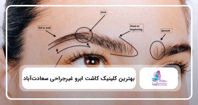 بهترین کلینیک کاشت ابرو غیرجراحی سعادت آباد ⭐【سال1405】